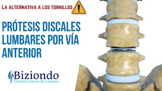 ▷▷Cirugía de columna lumbar sin tornillos Prótesis discales lumbares por vía abdominal  Biziondo [upl. by Phillida335]