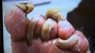 What is a fungal nail infectionMinnesota Podiatrist Explains wwwinnovativefootcarecom [upl. by Anstice]