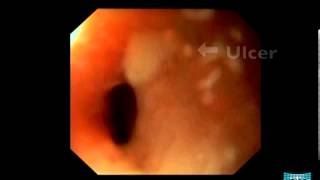 Endoscopic Appearance of Meckels Diverticulum [upl. by Studley155]