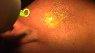 PIGMENTATION TREATMENT BY LASER At Radiance [upl. by Ahtnams]