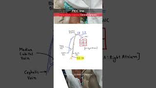 Peripheral Inserted Central Catheter PICC neetpg inicet [upl. by Yaron340]