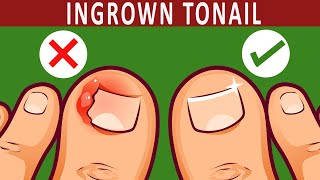 How to Get rid of Ingrown Toenail Naturally  10 Home Remedies [upl. by Yetah957]