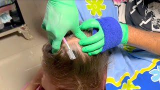 ASMR Scalp Check Scratching Gentle  Hairline Massage amp Cleaning  Scalp Sounds [upl. by Atinuhs]