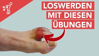 3 effektive Krallenzehen Übungen und Hammerzehen│ SanoGym [upl. by Eelrefinnej]