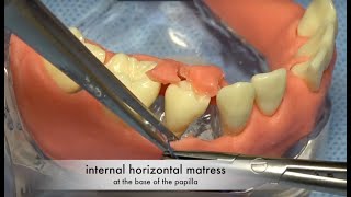 Periodontal Regenerative Emdogain Surgery with Papilla preservation  Flap design and suturing [upl. by Crystie]