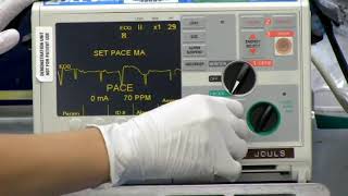 Transcutaneous cardiac pacing in a patient with thirddegree heart block [upl. by Kcid]