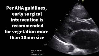 Cardiac vegetations in focus [upl. by Risa]