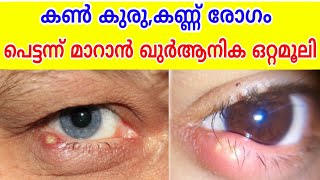 quranic dua to cure eye stye and eye problems  കൺകുരു മാറാൻ ഖുറാനിക മരുന്ന് [upl. by Eiuol]