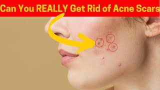 Can You REALLY Get Rid of Acne Scars in 2 Ways [upl. by Gairc]