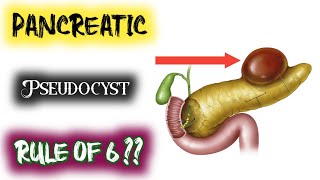 rule of six in pancreatic pseudocyst  rule of 6 [upl. by Asiralc]