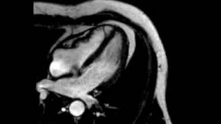 Constrictive pericarditis fourchamber ECGgated cine SSFP MR [upl. by Corina534]