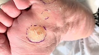 Callus removal from feetampFoot scraping dead skin [upl. by Holmes578]