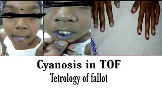 Tetrology of Fallot  TOF  Central cyanosis DrGurukumar [upl. by Ecnatsnok]