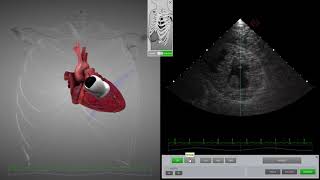 HeartWorks Hypovolemia with Doppler [upl. by Norvan]