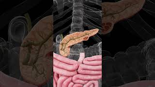 🔬 Mucinous Cystic Neoplasm of the Pancreas Understanding the Risks [upl. by Alethia]