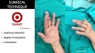 Percutaneous intramedullary screw fixation of metacarpal and phalangeal fractures [upl. by Freud192]