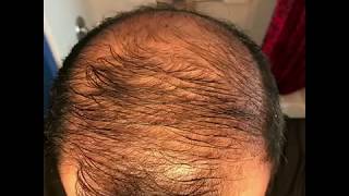 10 months using minoxidil  Rogaine 5 Before amp After results [upl. by Ymaral617]