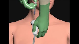 Central Line Placement by Cal Shipley MD [upl. by Mae]