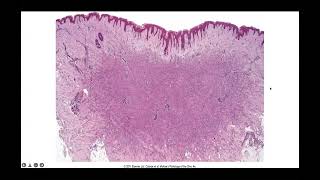 Fibrohistiocytic neoplasms from benign to malignant [upl. by Adihsar]