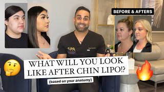 How Youll Look After Chin Lipo Before and After [upl. by Enened]