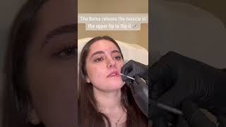 Botox lip flip at SEV Laser [upl. by Algie]