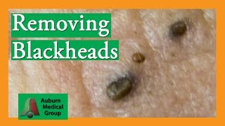 Several Blackheads  Auburn Medical Group [upl. by Akinyt]