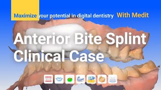 Clinical case  Anterior Bite Splint [upl. by Llovera614]