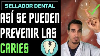 Cómo PREVENIR las CARIES en NIÑOS  SELLADORES de fosetas y FISURAS [upl. by Sauncho]