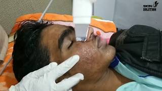 what is a hydrafacial treatment dermabrasion face deep cleaning [upl. by Anij916]