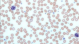 Diagnosis of Anaemia खून की कमी Peripheral Blood Smear [upl. by Sew]