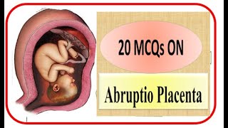 20 MCQs on Abruptio Placenta Definition risk factors diagnosis management and complications [upl. by Rosner]