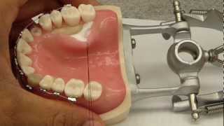 Palatal Flap Elevation Assistance  Connective tissue graftCrown Lengthening [upl. by Hayikat312]