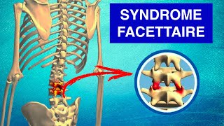 SYNDROME FACETTAIRE  Cause Symptômes et Traitements [upl. by Bishop]