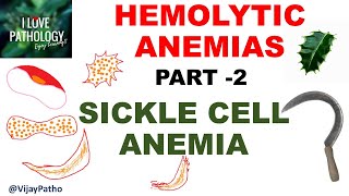 Hemolytic Anemias Part 2 SICKLE CELL ANEMIA Pathology [upl. by Ehcsrop]