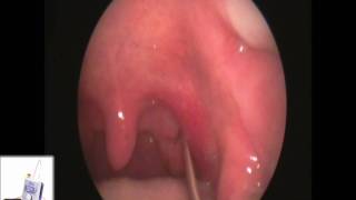 Tonsil Stone Extraction with Laser Cryptolysis [upl. by Euqinobe]