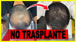 RECUPERACIÓN de CABELLO SIN TRASPLANTE CAPILAR  Mi Caso real [upl. by Rebah917]