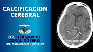 CALCIFICACION CEREBRAL [upl. by Hakilam]