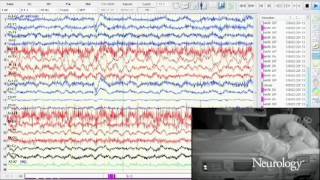 Ictal waterseeking in nondominant temporal lobe seizures [upl. by Atteuqram]