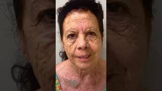 Peelling 5D antes e depois pele rugas peeling botox beleza antesedepois detox pelelimpa spa [upl. by Delora]