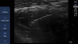 Proximal approach for ultrasoundguided infraclavicular brachial plexus block [upl. by Winshell]