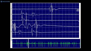 Kimura amp Kohara F32 Typical fasciculation potentials [upl. by Menendez48]