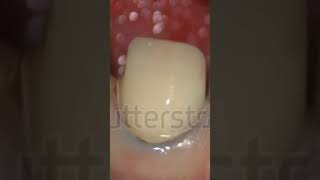 Anterior crown preparation [upl. by Ahcas]