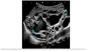 Posterior Urethral Valve Imaging [upl. by Gloria17]