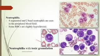 Practical Hematology 11 Morphology of Benign WBCs disorders [upl. by Letsirc]