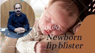 Newborn lip blister what causes them and when to treat [upl. by Esnahc133]