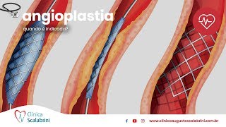 Quando é Indicada a Angioplastia [upl. by Atinnek]