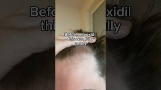 This Is How Much Hair I Have Regrown Using Minoxidil [upl. by Buskirk786]