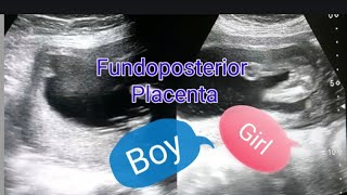 Fundoposterior placenta  Anterior placenta means baby boy  Posterior placenta means baby girl [upl. by Inalej562]