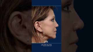 Facelift Before amp After  10 year Facelift Results [upl. by Hoon61]