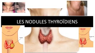 nodule thyroïdienne  part 2 [upl. by Eggett897]